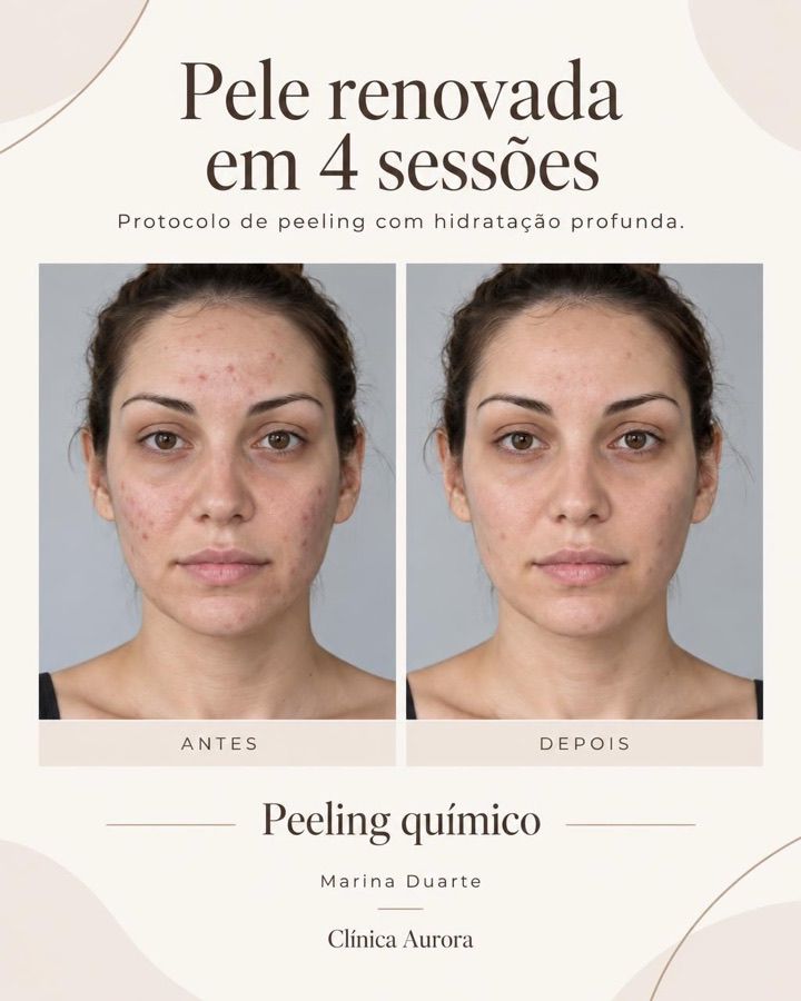 Exemplo de post para o feed no modelo Antes e depois clássico, com a frase Pele renovada em 4 sessões.